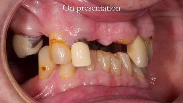 Managing Edgar “THE SCEPTIC” with an RPD/Splint FULL CASE