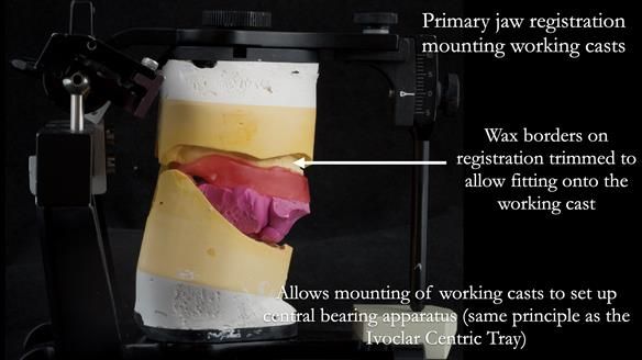 Newsletter 65 Marisa Provision of Complete Dentures on badly placed implants