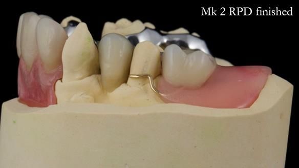 Newsletter 71 Jean’s Class I Mod III RPD: See my mistakes Fractured Mk1 to a Stronger Mk2 RPD (4 years on)