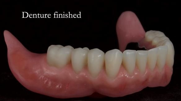 Newsletter 70 Complete Denture Treatment for Kate: A Case Study on Natural-Looking Dentures and Implant-Supported Overdentures