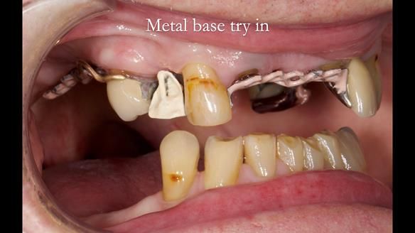 Managing Edgar “THE SCEPTIC” with an RPD/Splint FULL CASE