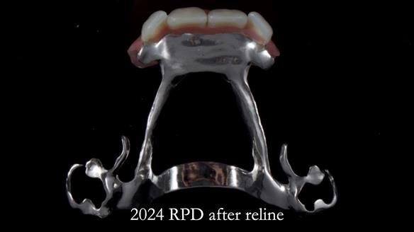 Newsletter 66 Long term case study. Life changing metal based RPD made for Anna