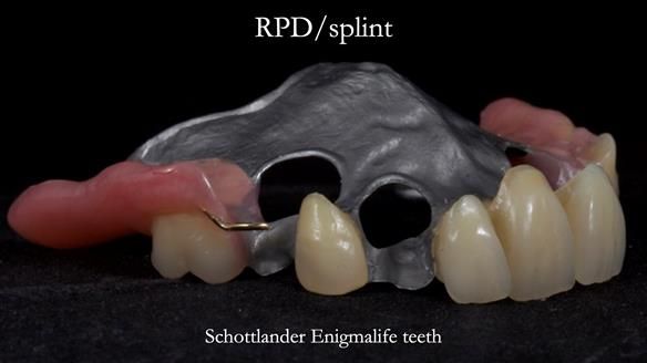 Managing Edgar “THE SCEPTIC” with an RPD/Splint FULL CASE