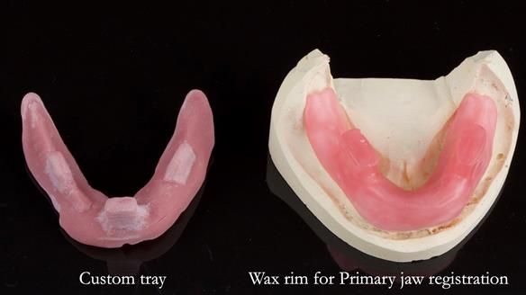 Newsletter 44 - extreme removable prosthodontics – engineering a super-strong and ultra-thin over denture