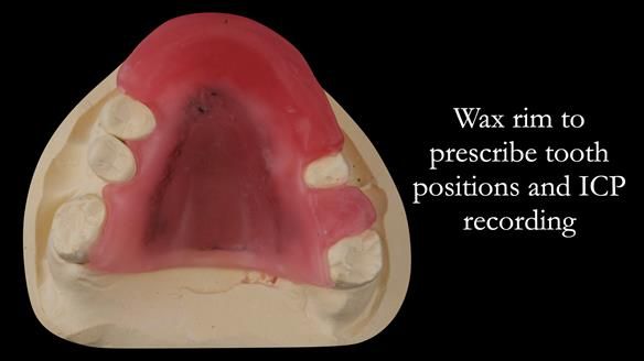 Eileen's transformation with upper and lower RPDs of Scandinavian hygienic design FULL PROTOCOL