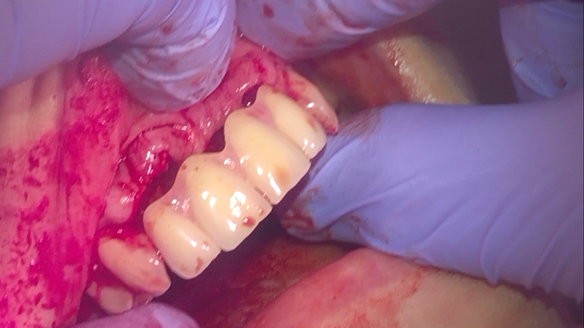 Figure 27 Immediate denture not seating owing to thick soft tissue - incsial papilla