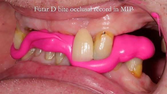 Managing Edgar “THE SCEPTIC” with an RPD/Splint FULL CASE