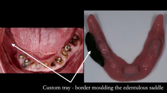 Newsletter 44 - extreme removable prosthodontics – engineering a super-strong and ultra-thin over denture