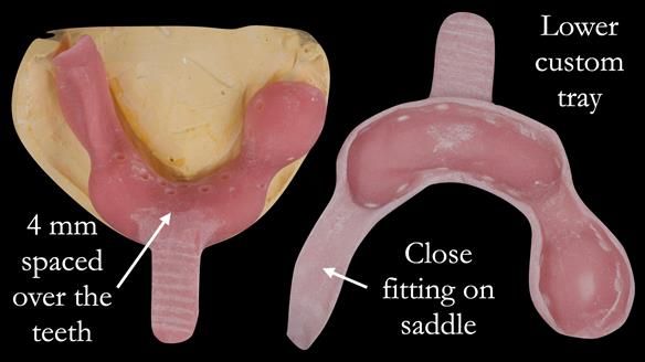 Eileen's transformation with upper and lower RPDs of Scandinavian hygienic design FULL PROTOCOL