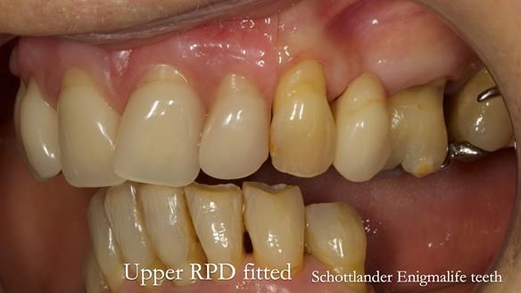 Newsletter 71 Jean’s Class I Mod III RPD: See my mistakes Fractured Mk1 to a Stronger Mk2 RPD (4 years on)