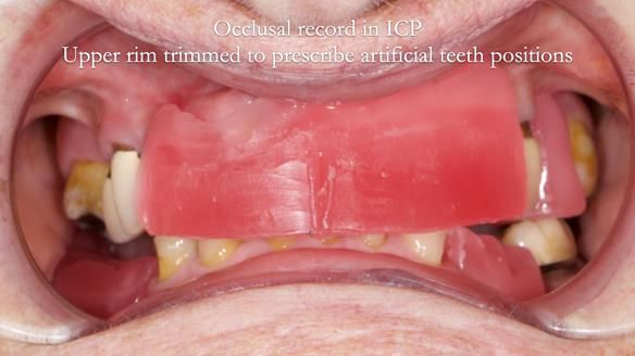 Eileen's transformation with upper and lower RPDs of Scandinavian hygienic design FULL PROTOCOL