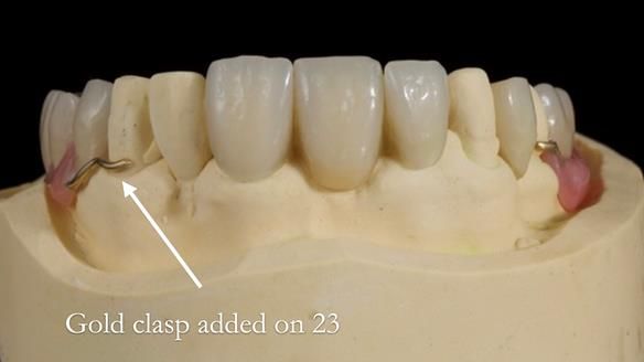 Managing Edgar “THE SCEPTIC” with an RPD/Splint FULL CASE