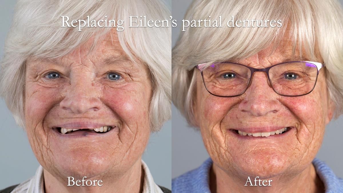 Eileen's transformation with upper and lower RPDs of Scandinavian hygienic design FULL PROTOCOL