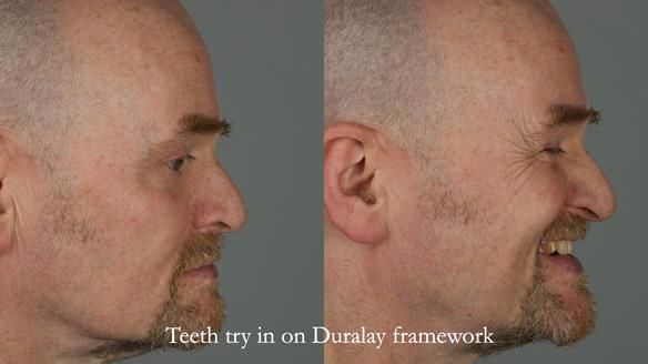 How Keith’s combat denture transformed his life – Newsletter 73