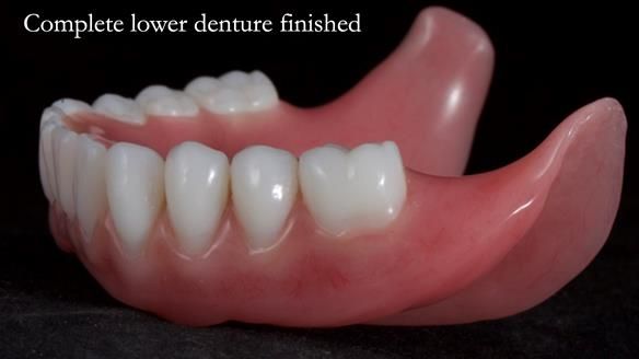 Newsletter 65 Marisa Provision of Complete Dentures on badly placed implants