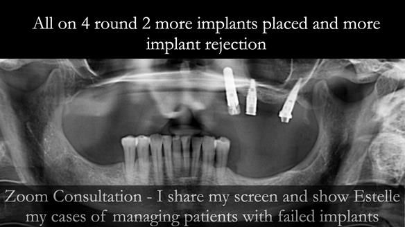 Newsletter 49 Managing Estelle’s failing implants with dentures FULL PROTOCOL