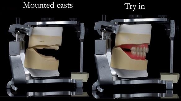 Newsletter 70 Complete Denture Treatment for Kate: A Case Study on Natural-Looking Dentures and Implant-Supported Overdentures