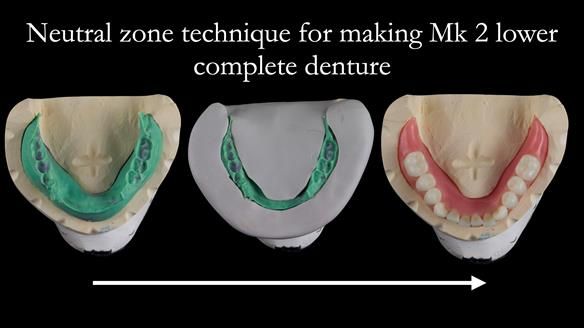 Replacing Madeline’s Complete denture FULL PROTOCOL