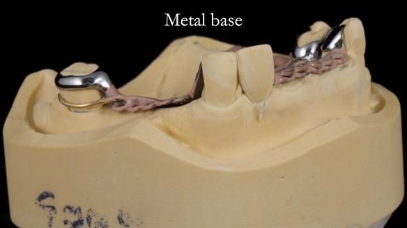 Managing Edgar “THE SCEPTIC” with an RPD/Splint FULL CASE