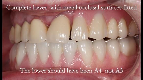 Newsletter 44 - extreme removable prosthodontics – engineering a super-strong and ultra-thin over denture