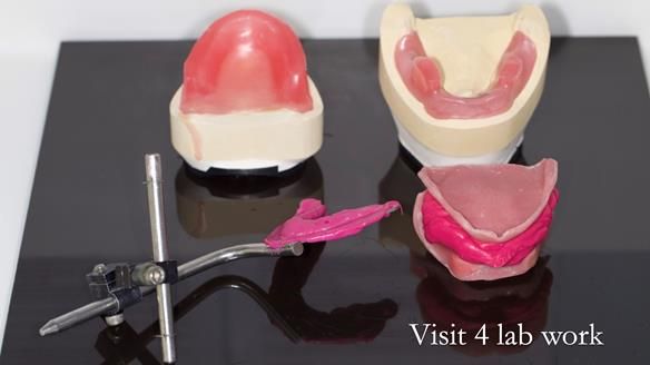 Newsletter 49 Managing Estelle’s failing implants with dentures FULL PROTOCOL