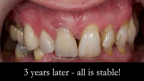 Read Newsletter 67 - Brian's COMBAT DENTURE Case Study