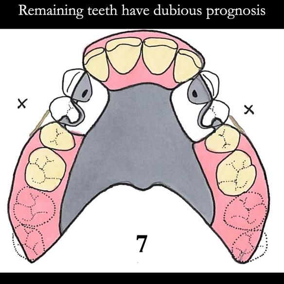 Universal Scandinavian partial denture designs