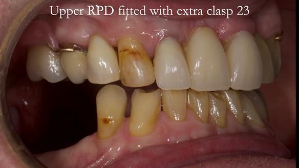 Managing Edgar “THE SCEPTIC” with an RPD/Splint FULL CASE