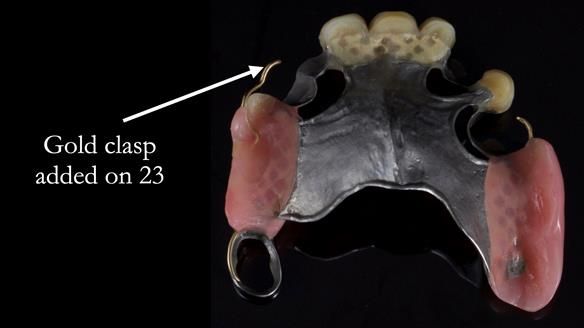 Managing Edgar “THE SCEPTIC” with an RPD/Splint FULL CASE