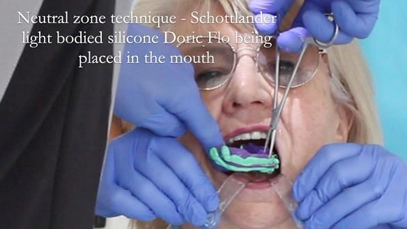 Replacing Madeline’s Complete denture FULL PROTOCOL