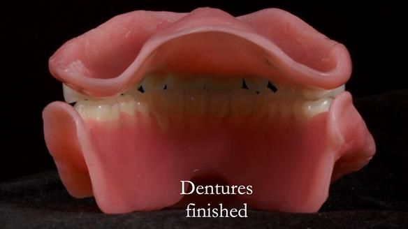 Newsletter 68 Restoring Jan’s Smile: Complete Dentures Inspired by Her Daughter’s Teeth - Post Mouth Surgery