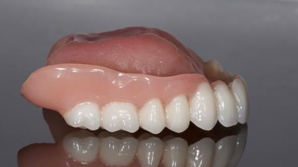 Newsletter 70 Complete Denture Treatment for Kate: A Case Study on Natural-Looking Dentures and Implant-Supported Overdentures