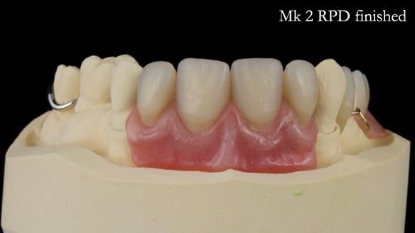 Newsletter 71 Jean’s Class I Mod III RPD: See my mistakes Fractured Mk1 to a Stronger Mk2 RPD (4 years on)