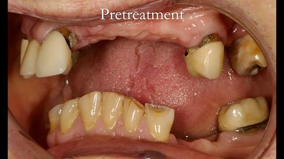 Eileen's transformation with upper and lower RPDs of Scandinavian hygienic design FULL PROTOCOL