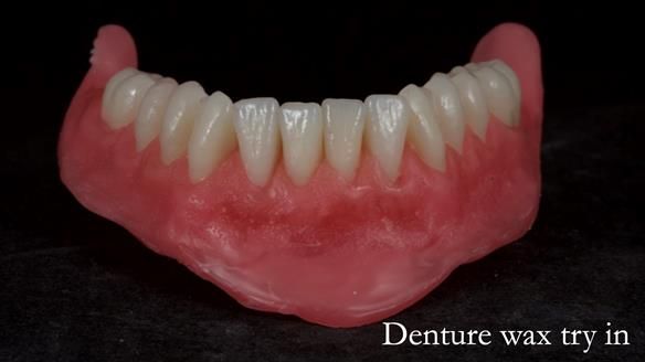 Newsletter 68 Restoring Jan’s Smile: Complete Dentures Inspired by Her Daughter’s Teeth - Post Mouth Surgery