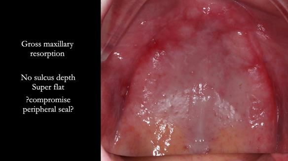 Replacing Madeline’s Complete denture FULL PROTOCOL