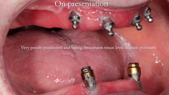 Newsletter 65 Marisa Provision of Complete Dentures on badly placed implants