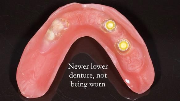 Newsletter 44 - extreme removable prosthodontics – engineering a super-strong and ultra-thin over denture