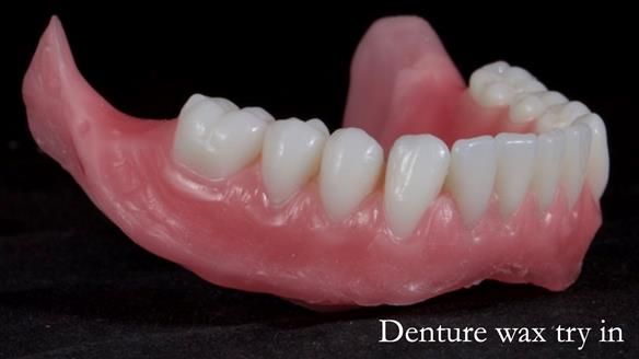 Newsletter 65 Marisa Provision of Complete Dentures on badly placed implants