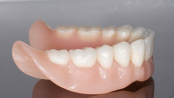 Newsletter 70 Complete Denture Treatment for Kate: A Case Study on Natural-Looking Dentures and Implant-Supported Overdentures