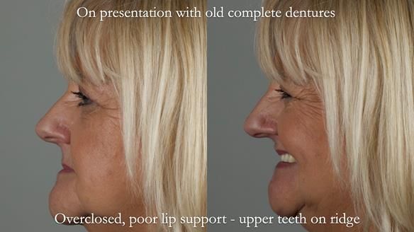 Newsletter 68 Restoring Jan’s Smile: Complete Dentures Inspired by Her Daughter’s Teeth - Post Mouth Surgery