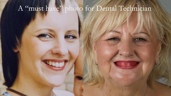 Newsletter 68 Restoring Jan’s Smile: Complete Dentures Inspired by Her Daughter’s Teeth - Post Mouth Surgery