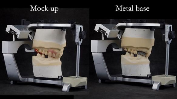 Read Newsletter 67 - Brian's COMBAT DENTURE Case Study