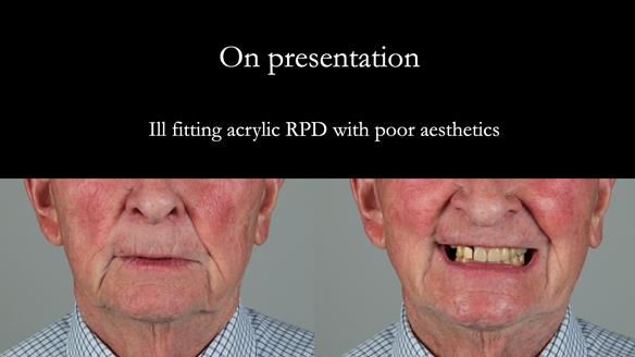 Managing Edgar “THE SCEPTIC” with an RPD/Splint FULL CASE