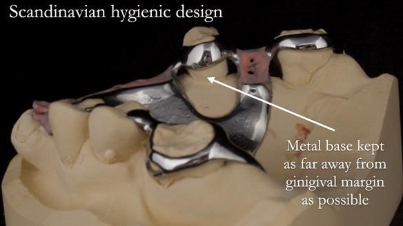 Eileen's transformation with upper and lower RPDs of Scandinavian hygienic design FULL PROTOCOL