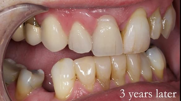 Read Newsletter 67 - Brian's COMBAT DENTURE Case Study