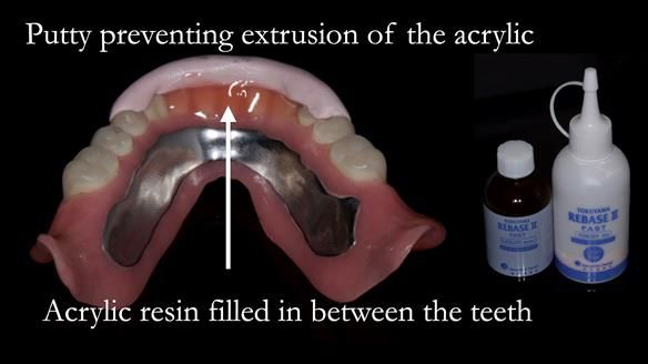 Newsletter 70 Complete Denture Treatment for Kate: A Case Study on Natural-Looking Dentures and Implant-Supported Overdentures