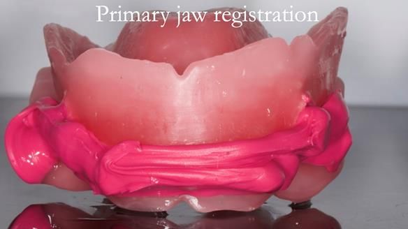 Newsletter 70 Complete Denture Treatment for Kate: A Case Study on Natural-Looking Dentures and Implant-Supported Overdentures