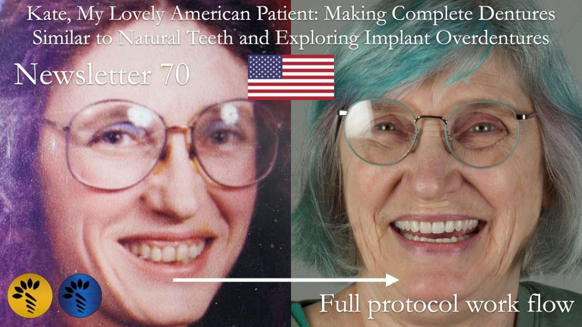 Newsletter 70 Complete Denture Treatment for Kate: A Case Study on Natural-Looking Dentures and Implant-Supported Overdentures