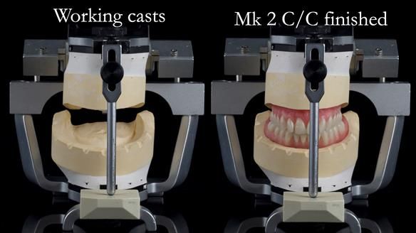 Replacing Madeline’s Complete denture FULL PROTOCOL